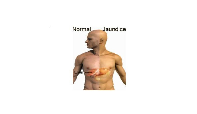 Surgical Jaundice Treatment in Sonbhadra