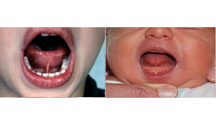 Tongue Tie Treatment in Mahoba