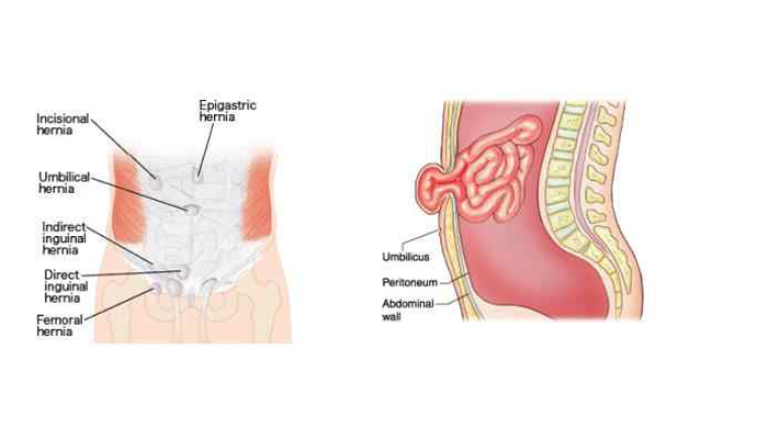 Umbilical Hernia Treatment in Ghaziabad