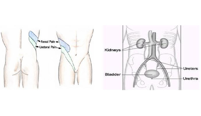 Ureteric Colic Treatment in Amroha