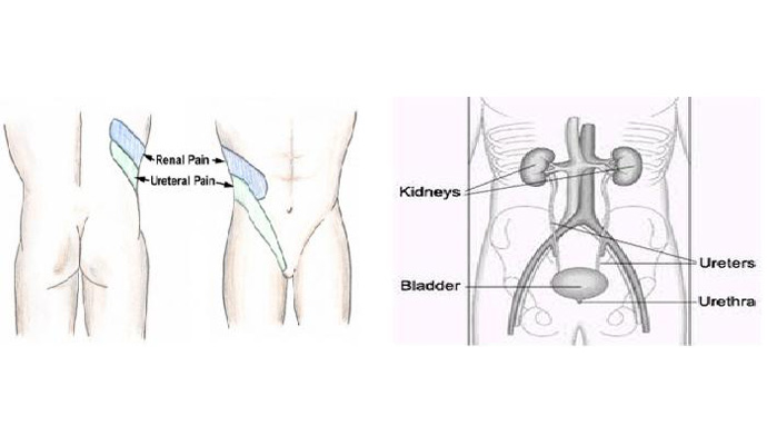 Ureteric Colic Treatment in Polytechnic