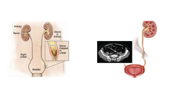 Ureteric Stone Treatment in Bistauli