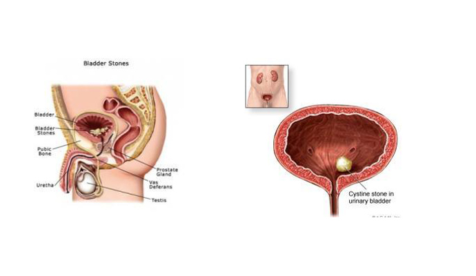 Urinary Bladder Stones Treatment in Agra