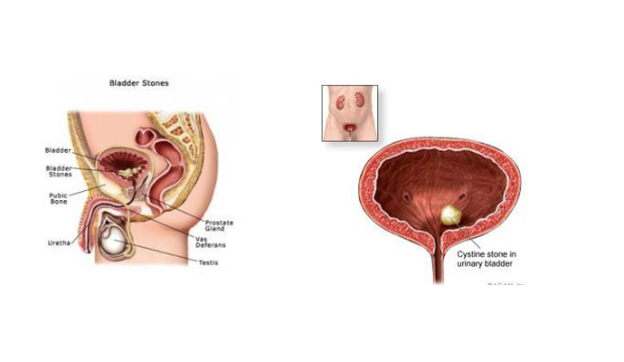 Urinary Bladder Stones Treatment in Mathura