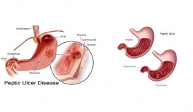 Acid Peptic Disease Treatment in Sambhal