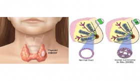 Breast And Thyroid Gland Tumors Treatment in Lucknow