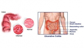 Colitis Treatment in Meerut