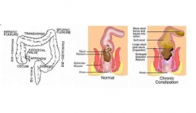 Constipation Treatment in Sant Ravidas Nagar