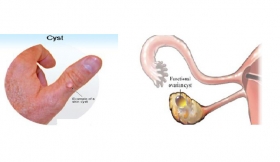 Cysts Operation all Cysts And Over Growths Treatment in Kaushambi