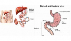 Duodenal Perforation Treatment in Amroha