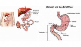 Duodenal Perforation Treatment in Rampur