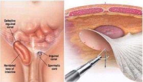 Hernia Surgeries Treatment in Sultanpur