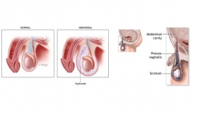 Hydrocoel Surgeries Treatment in Ambedkar Nagar