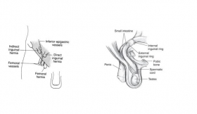 Indirect Inguinal Hernia Surgery Treatment in Maharajganj