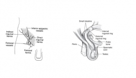 Indirect Inguinal Hernia Surgery