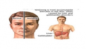 Jaundice Treatment in Aligarh