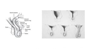 Pediatric Hernia Surgery Treatment in Bulandshahr