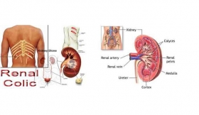 Renal Colic Treatment in Gonda