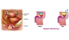 Urinary Retention Treatment in Maharajganj